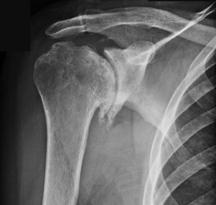 A radiografia mostrou artrose do ombro