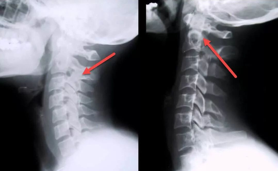 diagnóstico de osteocondrose cervical