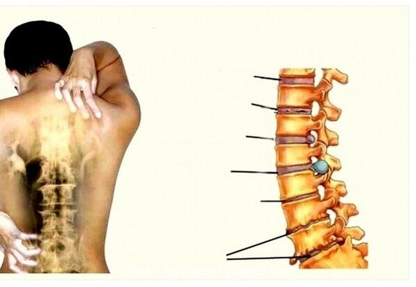 Estágios da osteocondrose cervical