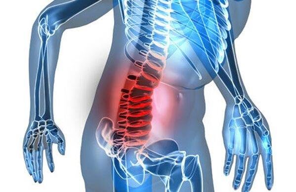Deformidade da coluna vertebral no quarto estágio da osteocondrose lombar