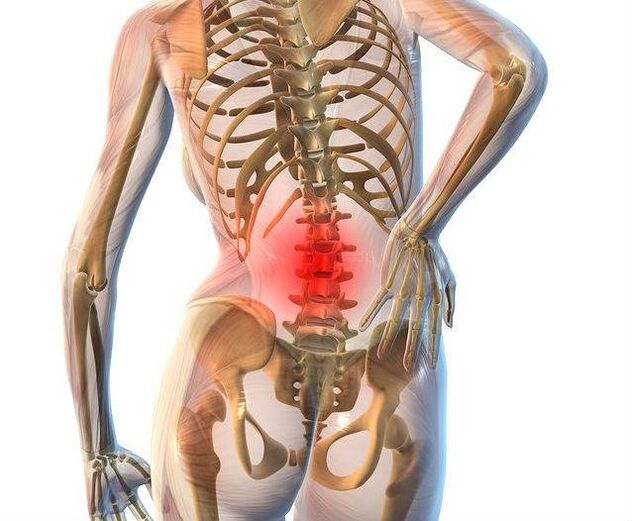 Osteocondrose da coluna lombar