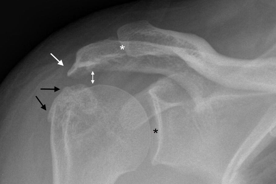 artrose da articulação do ombro na radiografia