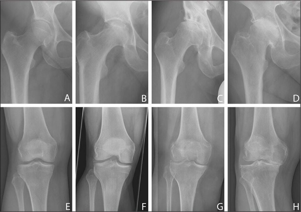 Estágios de desenvolvimento de artrose articular em uma radiografia