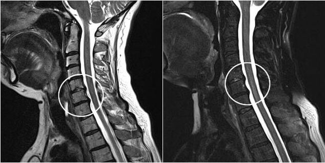 Ressonância magnética da coluna cervical com sinais de osteocondrose
